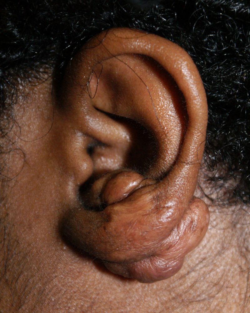 Keloid Scar Removal 2370 Pre