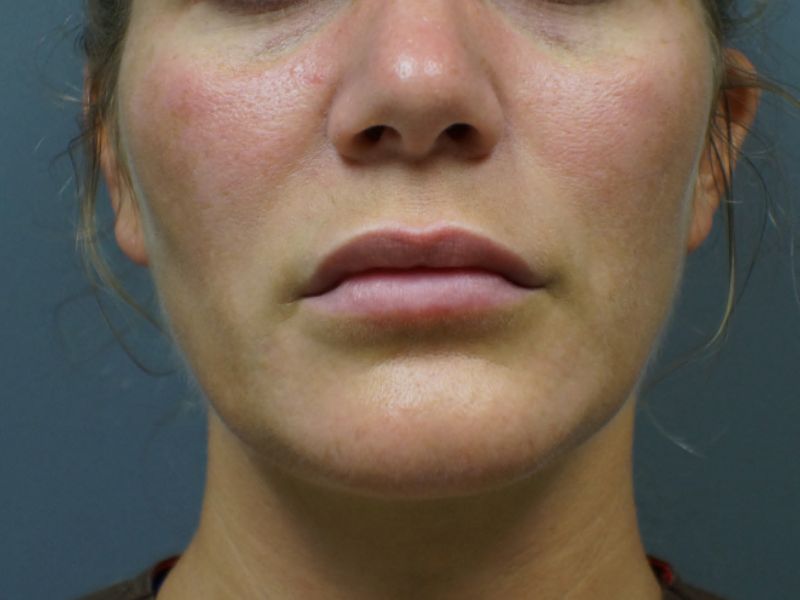 Lip Filler 8464 Post