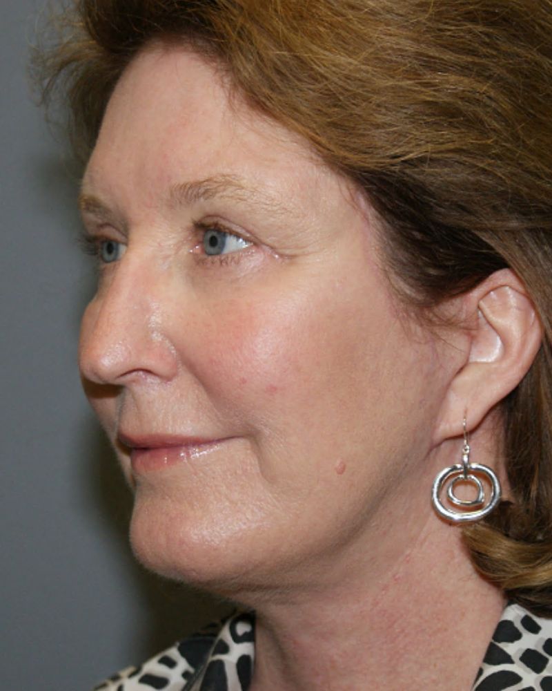 Neck lift and chin augmentation 5118 Post