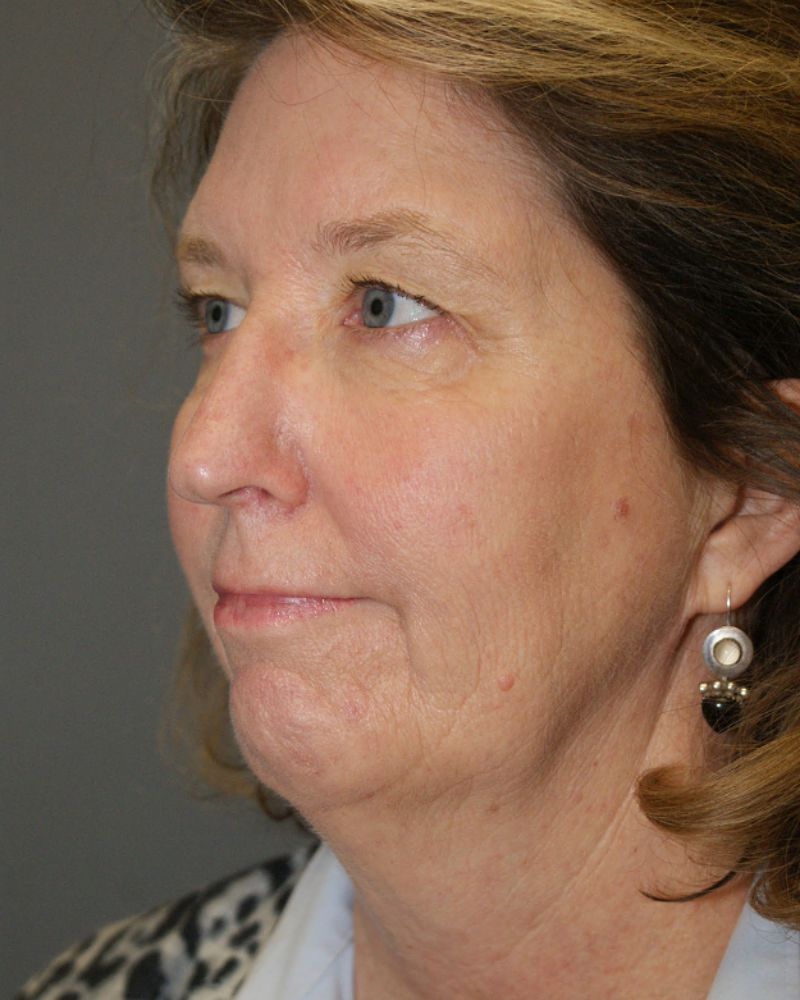Neck lift and chin augmentation 5118 Pre