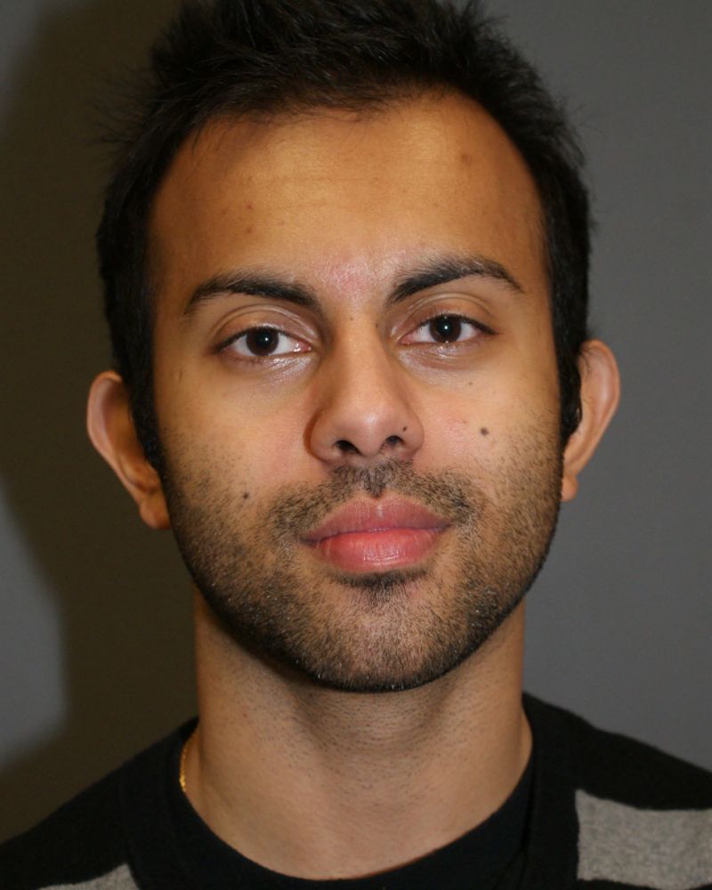 Otoplasty - Ear Surgery 4927 Pre