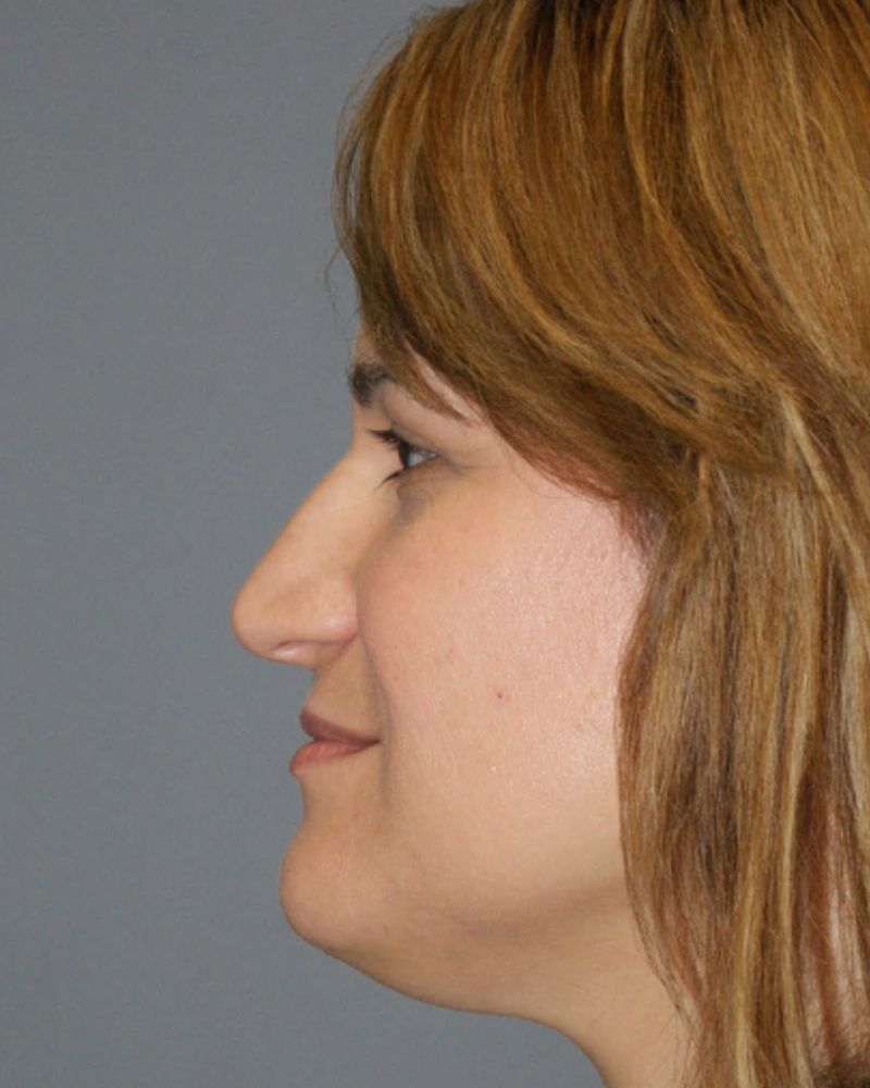 Rhinoplasty 4703 Pre