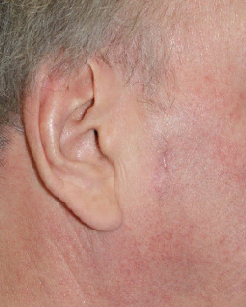 Skin cancer repair 1889 Post