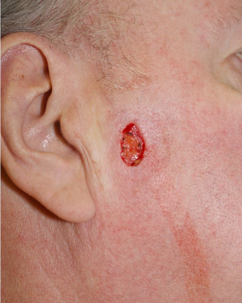 Skin cancer repair 1889 Pre