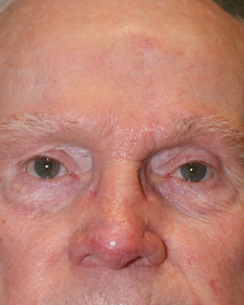 Skin cancer repair 4459 Post