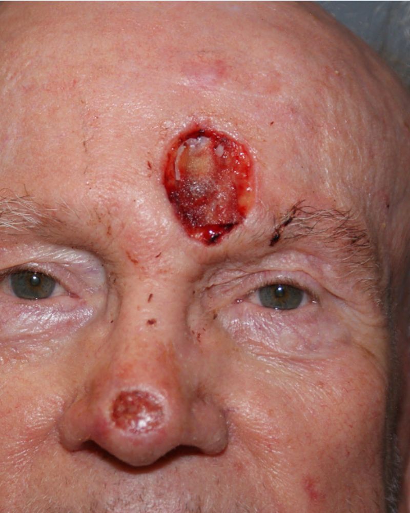 Skin cancer repair 4459 Pre