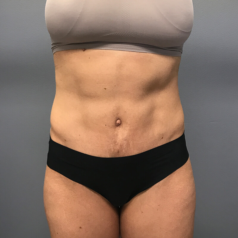 Abdominoplasty-Patient-13 | After Abdominoplasty