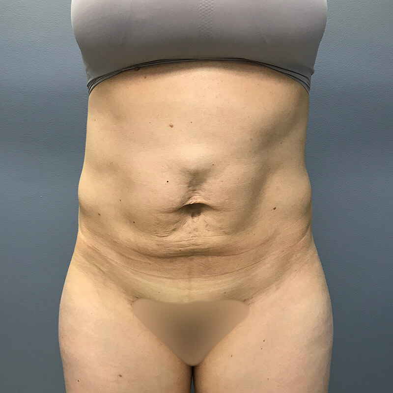Abdominoplasty-Patient-13 | Before Abdominoplasty