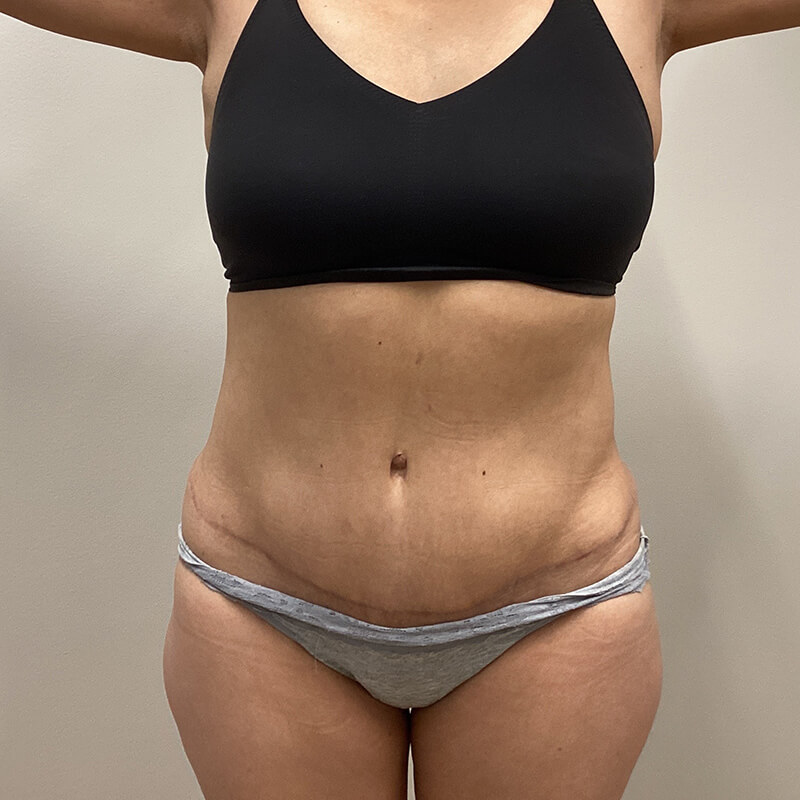 Abdominoplasty-Patient-14 | After Abdominoplasty