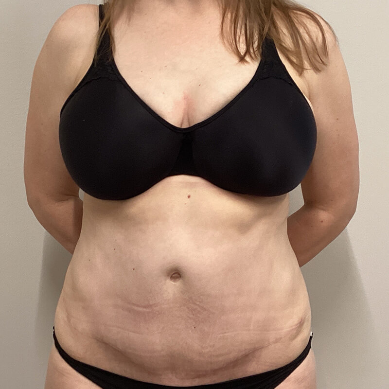 Abdominoplasty-Patient-15 | Before Abdominoplasty