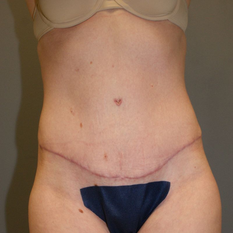 Tummy Tuck 2478 Post