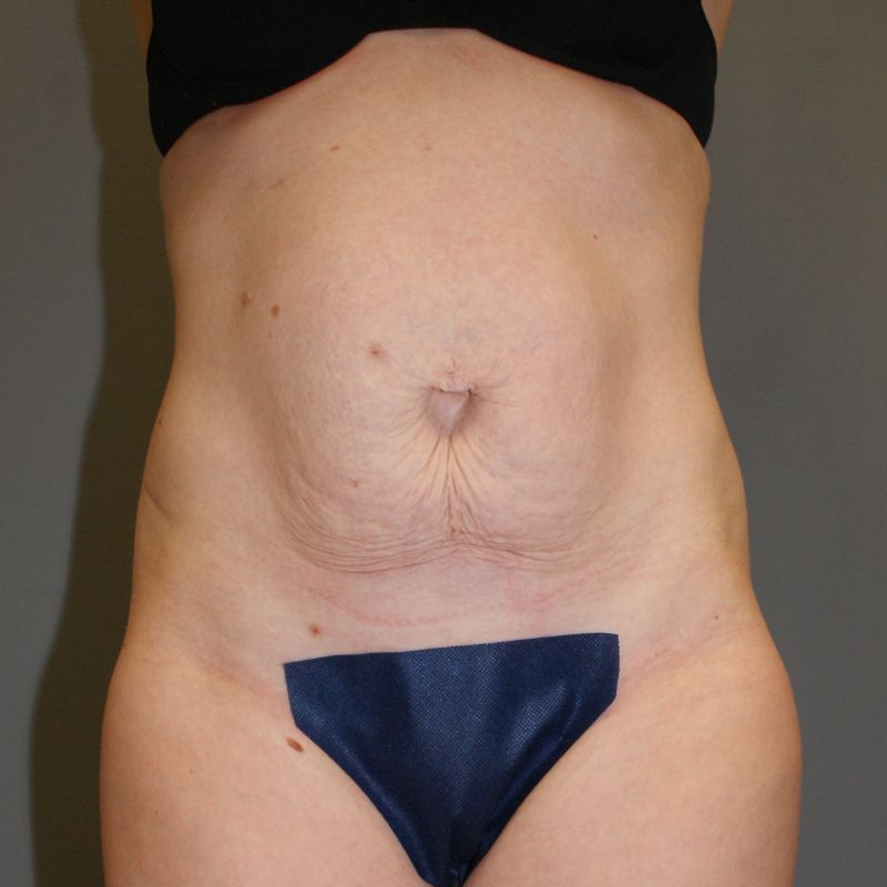 Tummy Tuck 2478 Pre