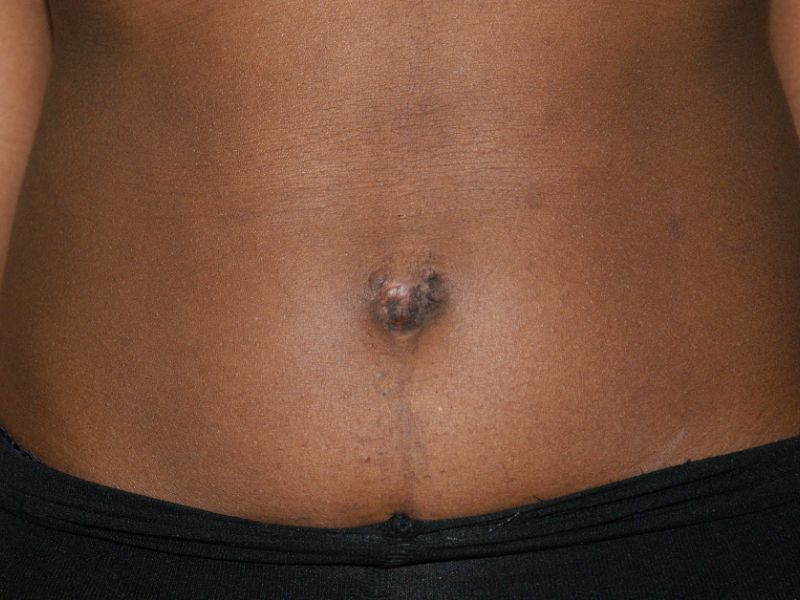 umbilicoplasty 4994 Post