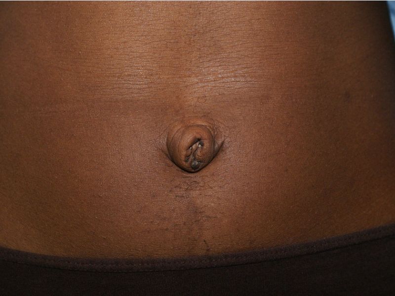 umbilicoplasty 4994 Pre