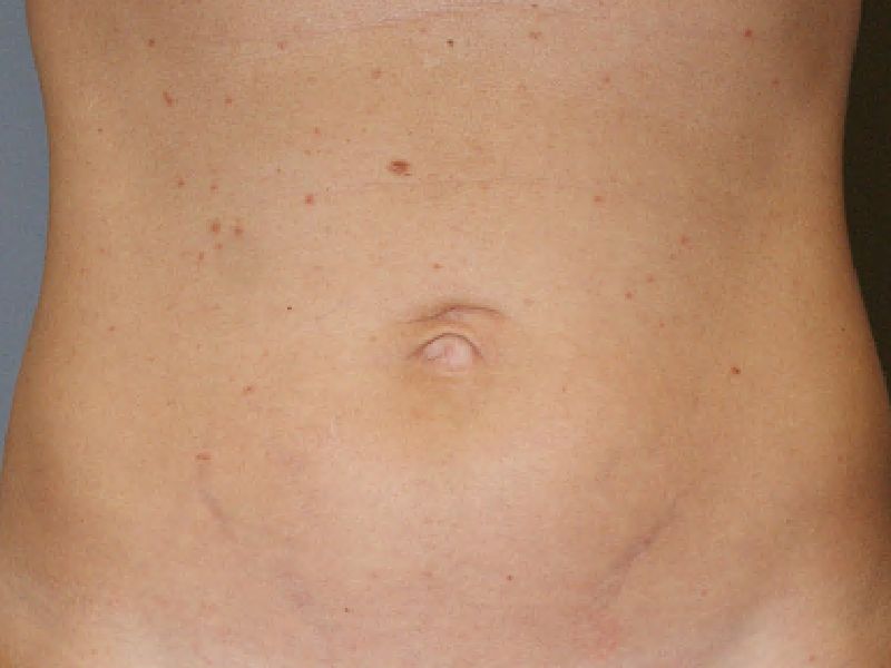 umbilicoplasty 5882 Pre
